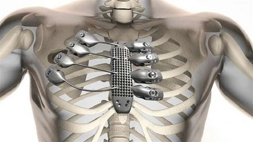 3D printed medical implants a